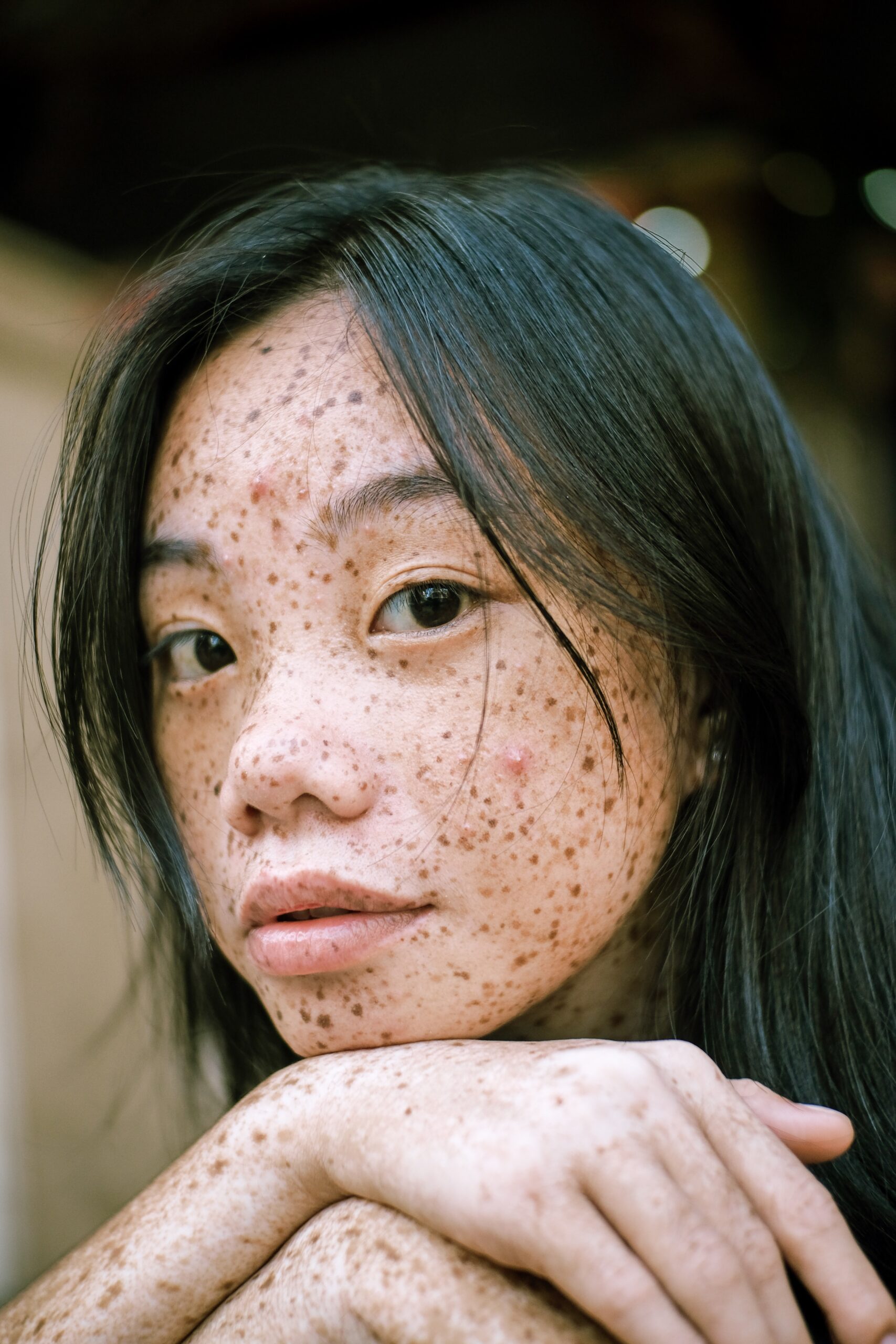 How to remove pigmentation from face permanently- Learn causes, symptoms, and home remedies